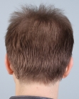 Before Hair Transplant&nbsp;2 Sessions (Areas)